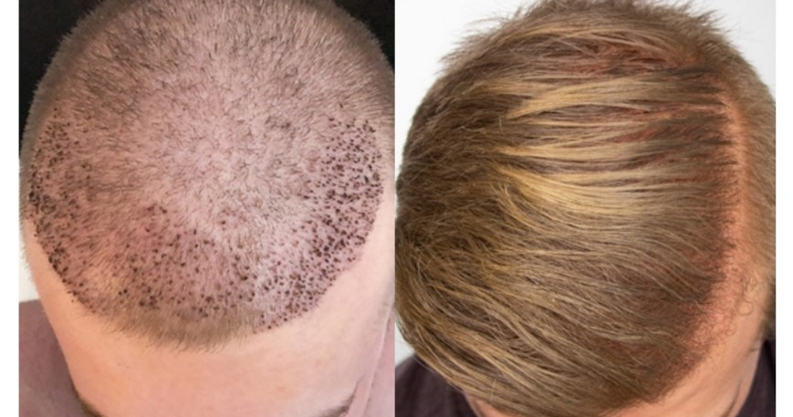The Safest Hair Restoration Methods