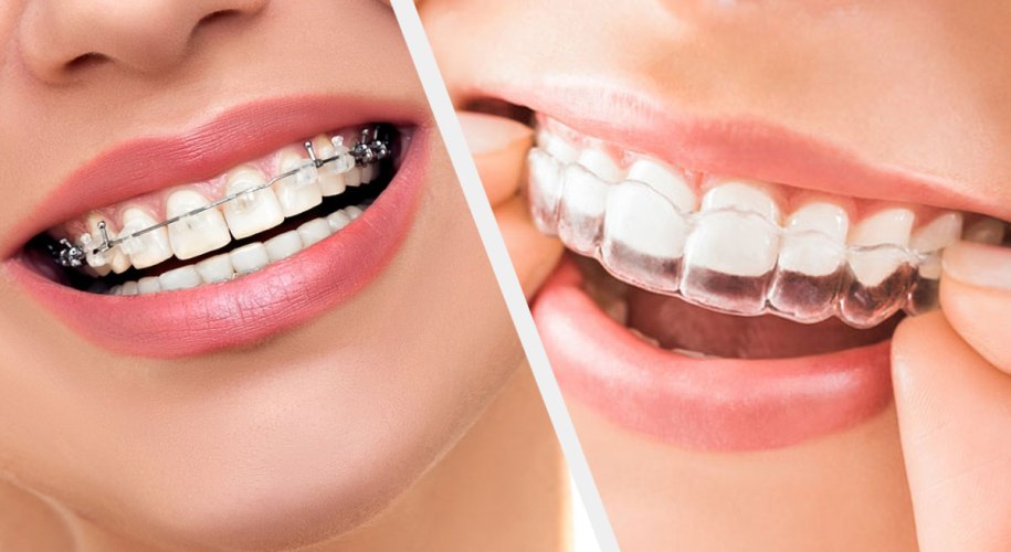 Orthodontic Treatment