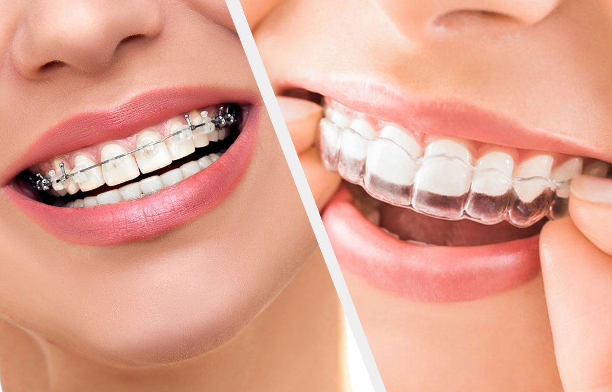 Orthodontic Treatment