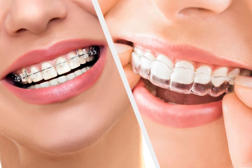 Main Reasons Why Invisalign is the Best Orthodontic Treatment